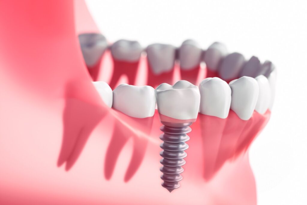 dental implant