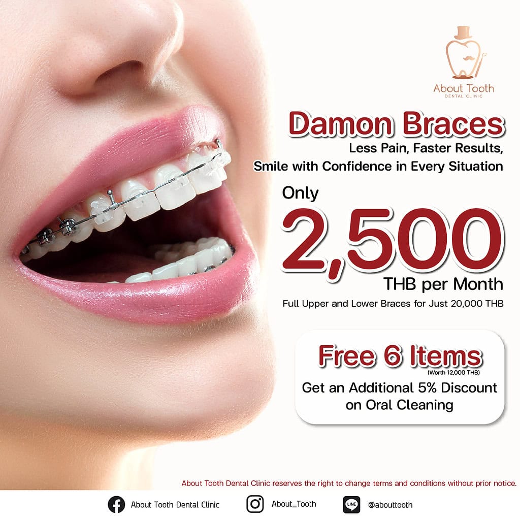 Damon Braces