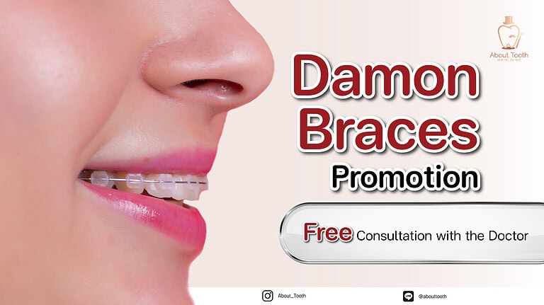 Damon Braces