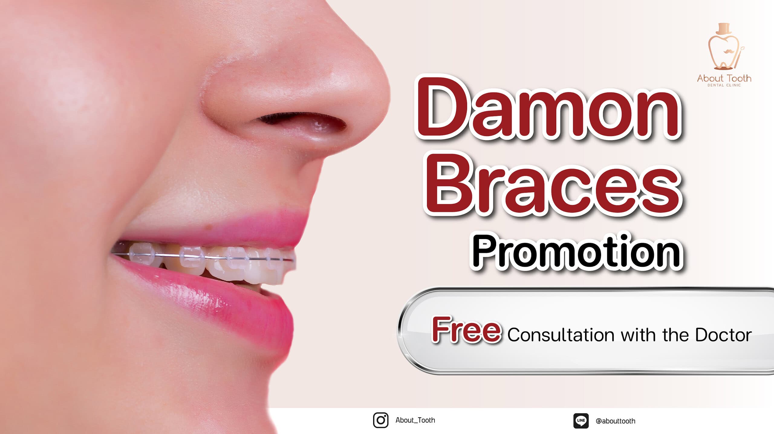 Damon Braces