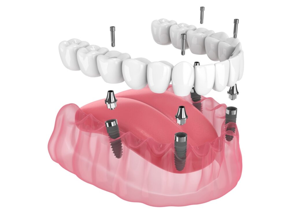 An all-on-4 type of dental implant.